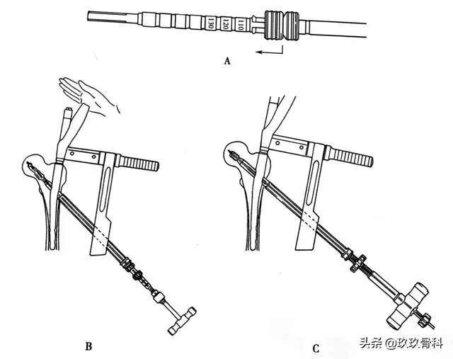 骨科常用的髓内钉，技术要点看这里