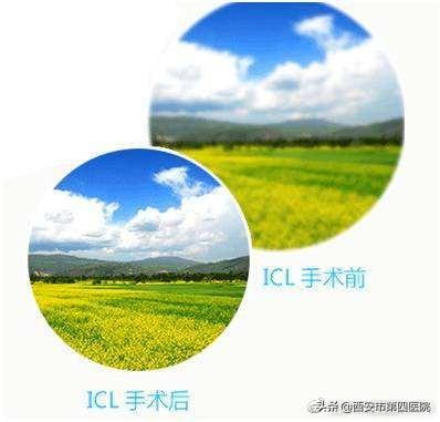 我们说说“高大上”的近视手术——ICL手术的相关问题