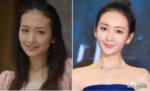 那些发际线被嘲出圈的女明星为什么不植发？