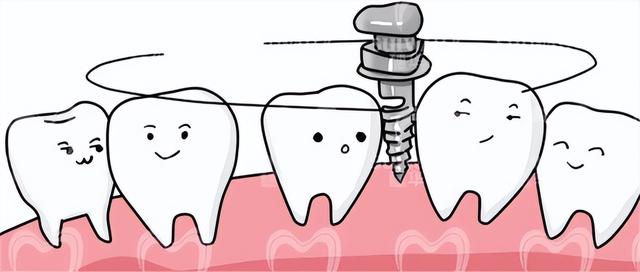 同样是种植牙，为什么有些人要植骨有些人却不用？