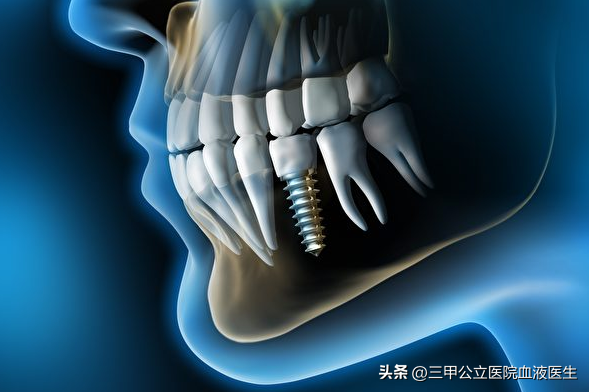 口腔医生绝对不会告诉你种植牙过程中的几点“秘密”