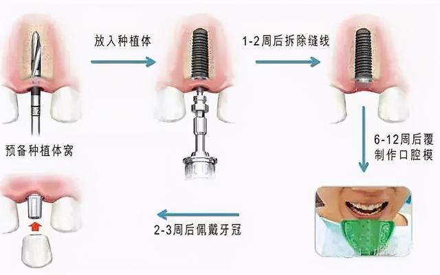 植入到口腔内的“螺丝”真的会生锈吗？看看专家怎么说