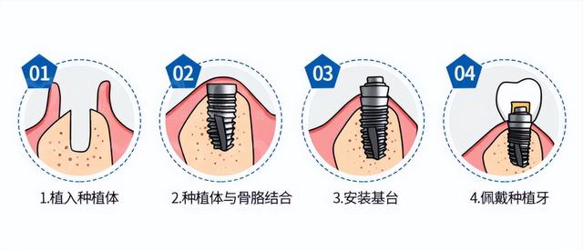 同样是种植牙，为什么有些人要植骨有些人却不用？