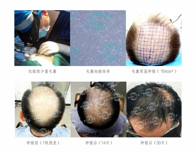 自研自体毛囊再生种植技术，「华科同济干细胞」成功临床应用大面积植发