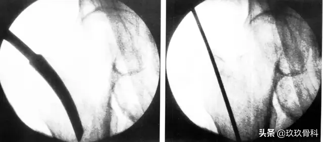 骨科常用的髓内钉，技术要点看这里