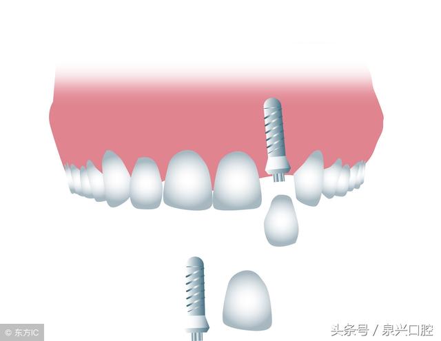 孩子恒牙掉了不必心疼捡起来 美牙冠来搞定