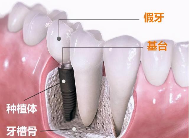 种植牙到底值不值得做？看完你就明白了。#雅悦齿科#