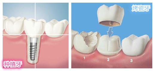 种植牙与烤瓷牙区别在哪？哪种缺牙修复方式更好？医师教您选择