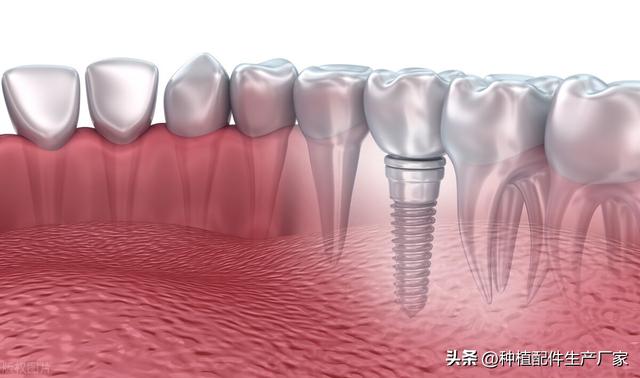 中国种植牙配件市场分析