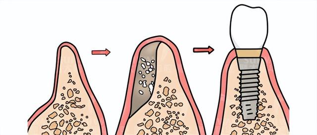 同样是种植牙，为什么有些人要植骨有些人却不用？