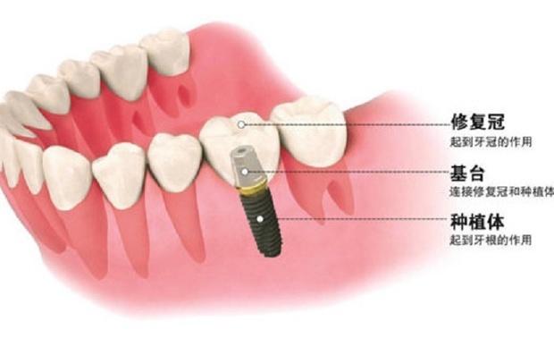 种植手术是不是一次完成？有关种植牙的那些事，牙科医生为你揭秘