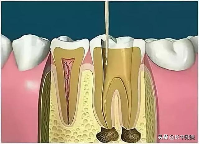 【科普】口腔中心告诉您根管治疗是怎么一回事