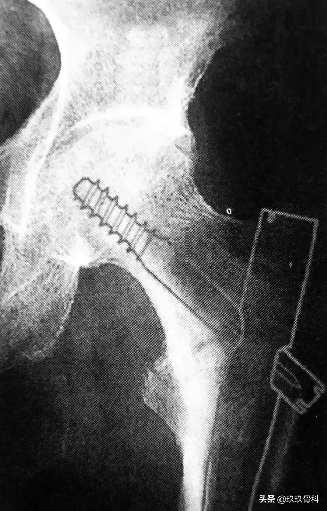骨科常用的髓内钉，技术要点看这里