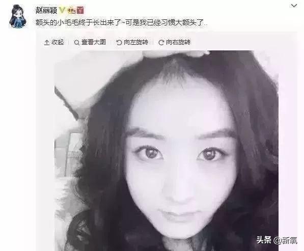 那些发际线被嘲出圈的女明星为什么不植发？