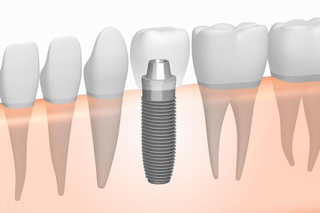 种植科普——牙齿种植需要多少钱？
