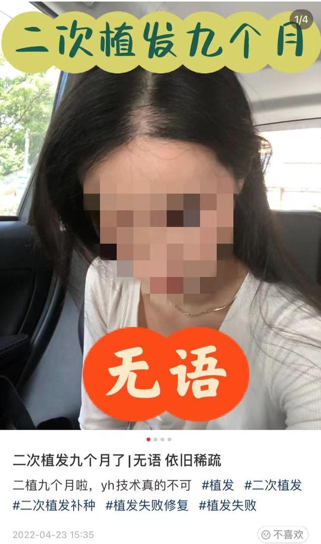 泛滥的脱发焦虑还是“人工植发”的消费陷阱？