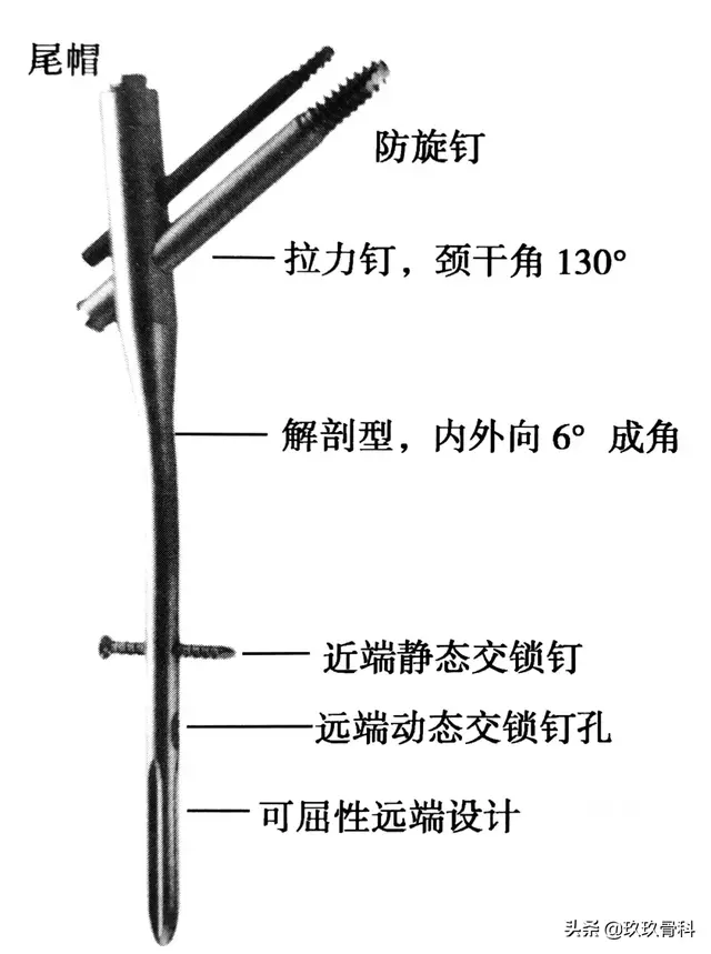 骨科常用的髓内钉，技术要点看这里