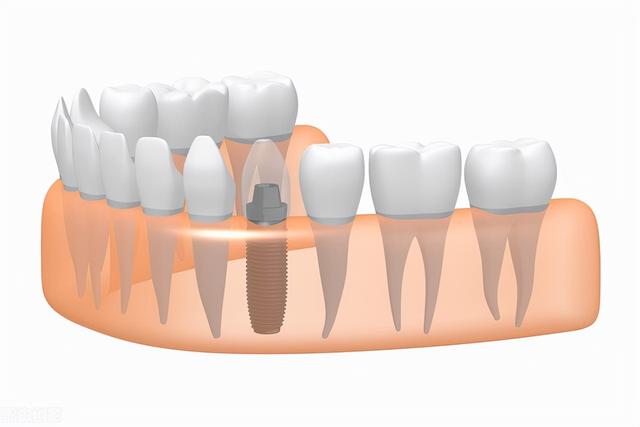 日常科普——牙齿种植有什么注意事项？