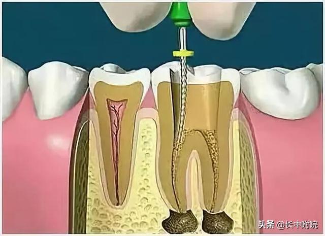 【科普】口腔中心告诉您根管治疗是怎么一回事