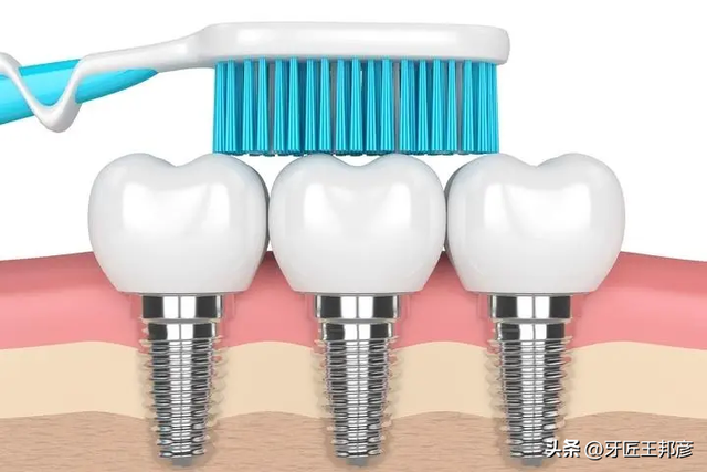 做了种植牙，可别忘了这份保养秘籍