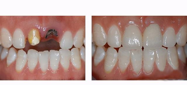 做完种植牙，要学会这5个保养方法！否则白种