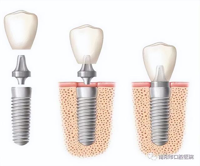 带你全面了解什么是种植牙、种牙过程、时机及后期维护
