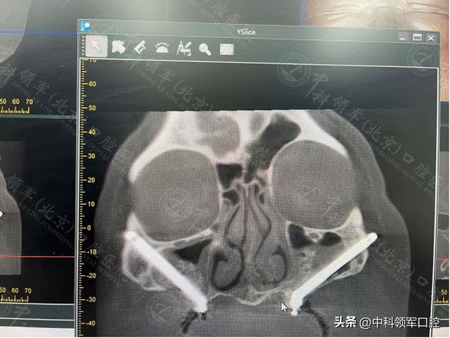 60岁被诸多医生判定无法做种植牙，遇珠峰级种植技术解决难题