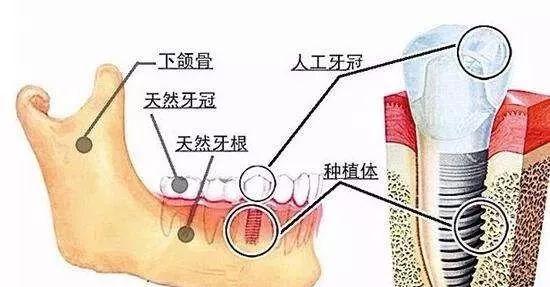 种植牙一定会成功吗，会不会失败？失败后都有什么后果