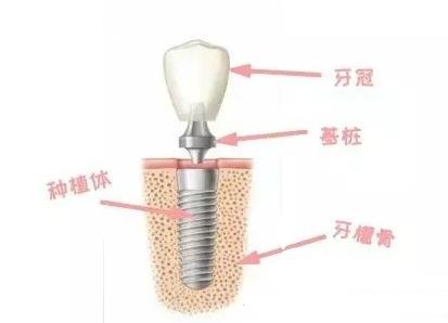 种植牙即拔即种后能马上使用吗？