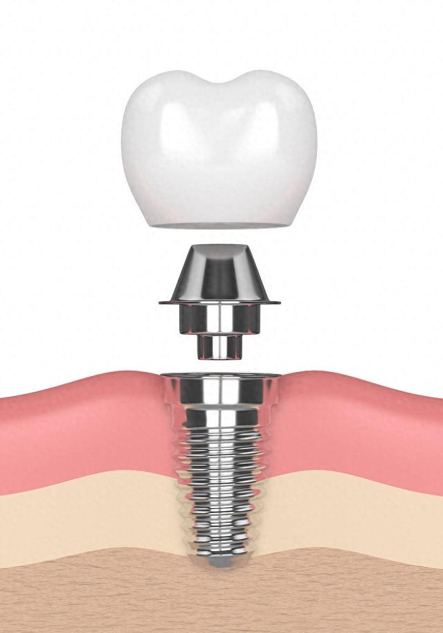 种植牙是怎么种植的？