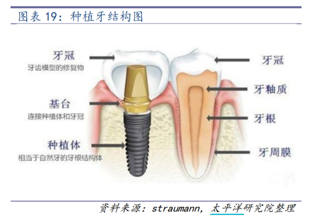种一颗牙上万将成历史？史上最难种植牙集采搅动千亿市场，牙茅何去何从