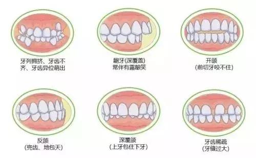 牙齿矫正中最担心的2件事，你中招了吗？