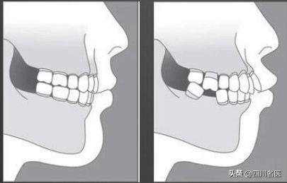 缺牙的危害竟然这么大？华西口腔满毅教授：最好的补救方式是……