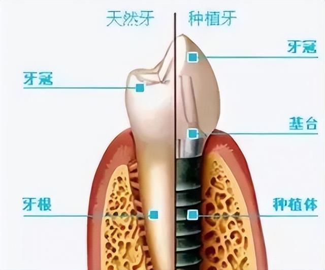 【名医名院】关于种植牙，你想知道的都在这里