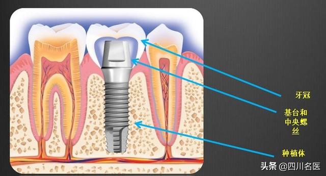 缺牙的危害竟然这么大？华西口腔满毅教授：最好的补救方式是……