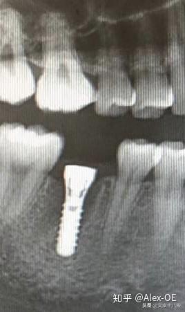 分享我的种牙植牙经历（坐标杭州）