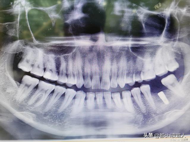 刚刚种完牙分享一下感受