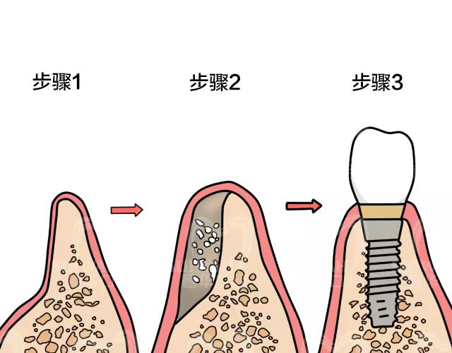 大连齿医生口腔科普 种植牙为什么还要填骨粉，可骨粉又是什么？