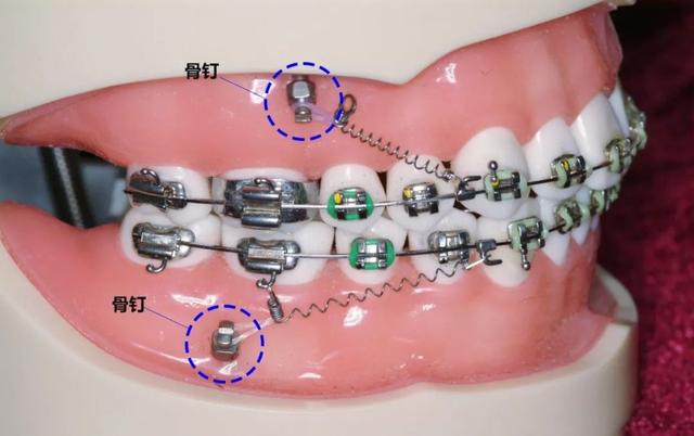 牙齿矫正一般是什么时候打骨钉？矫正是不是必须打骨钉？