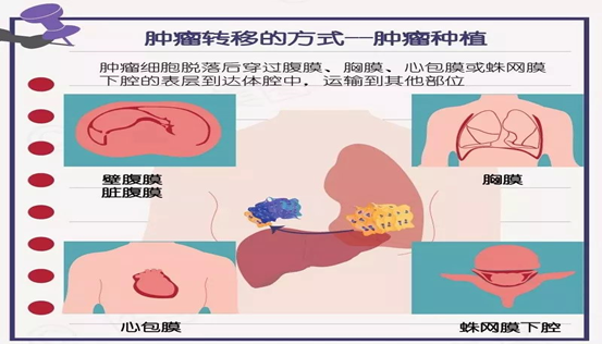 肿瘤没有脚，为什么会跑？