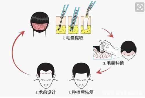 植发一个月后，他后悔了，植发到底“值不值”？这笔账你要会算