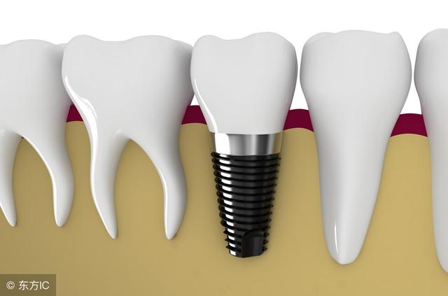 5000元和1万元的种植牙差距在哪里？