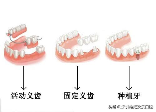 种植牙为什么会比活动义齿贵那么多呢？为你揭秘