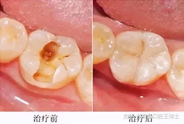 真牙的”救命稻草”——根管治疗，八大问题解答