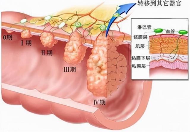 肿瘤没有脚，为什么会跑？