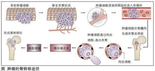 肿瘤没有脚，为什么会跑？