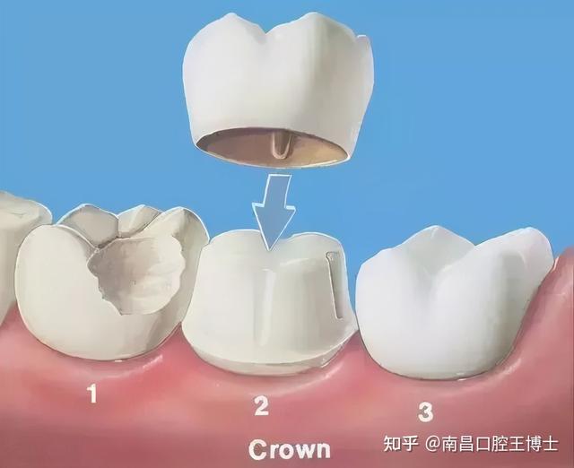 真牙的”救命稻草”——根管治疗，八大问题解答