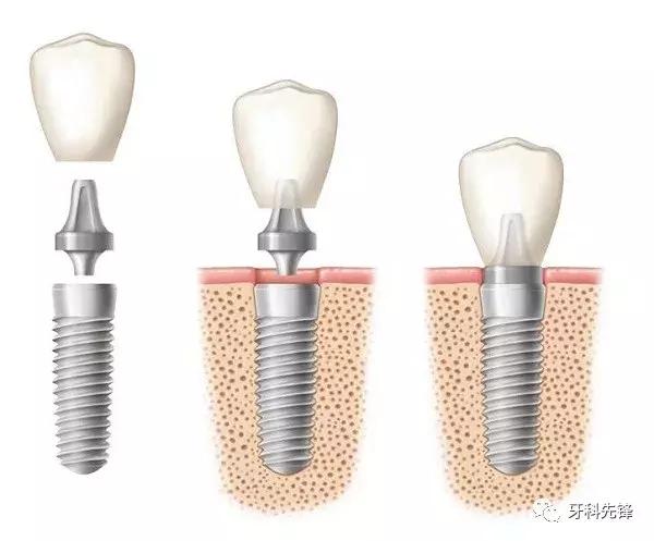 种植牙手术前、中、后应该注意哪些事项？
