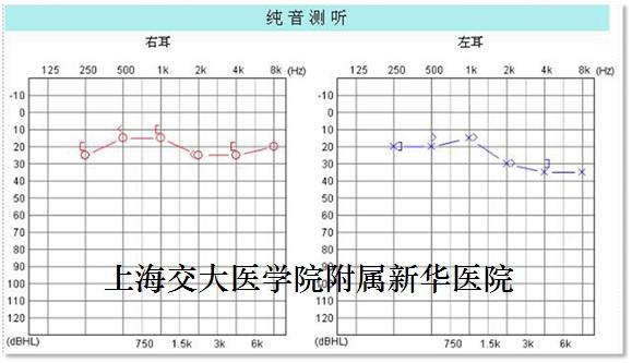 再说小听神经瘤