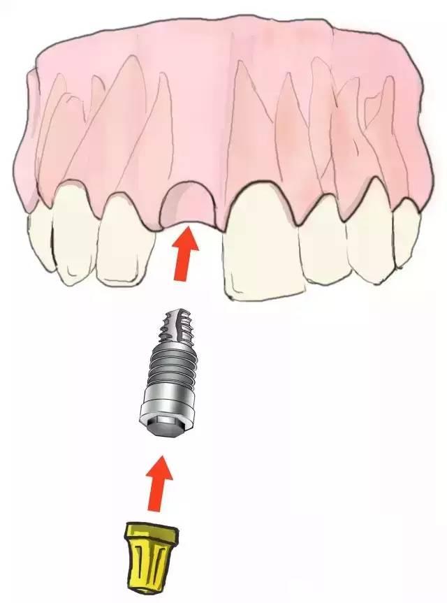史上最简单明了的种植牙介绍！（图）